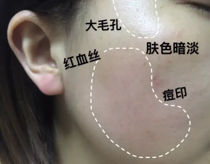 怎么样才能去红血丝(解析去红血丝有效的方法)插图1 怎么样才能去红血丝(解析去红血丝有效的方法)插图1