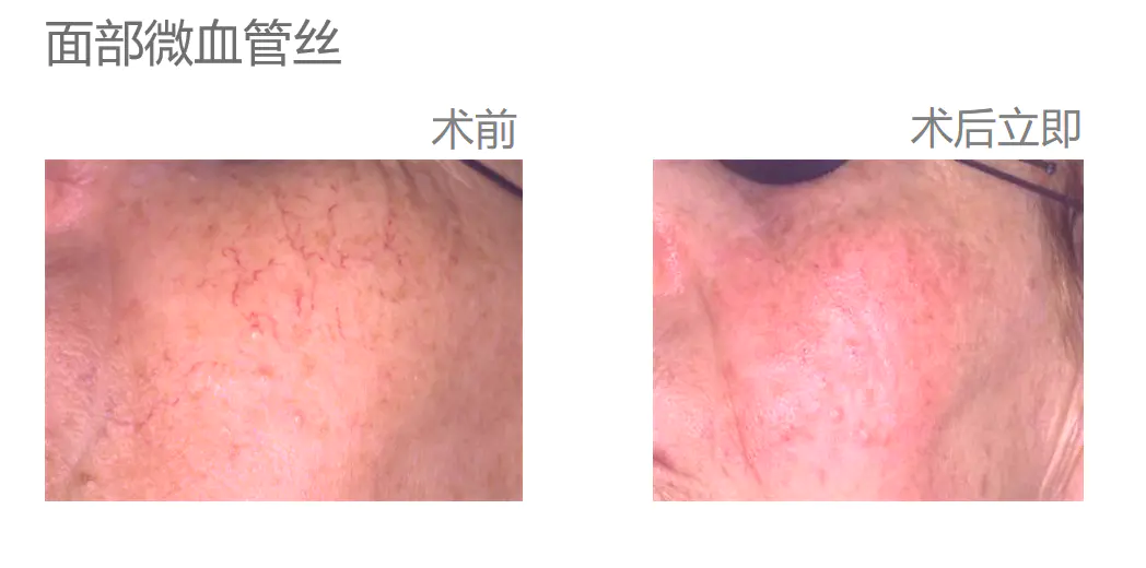 怎么样才能去红血丝(解析去红血丝有效的方法)插图2 怎么样才能去红血丝(解析去红血丝有效的方法)插图2
