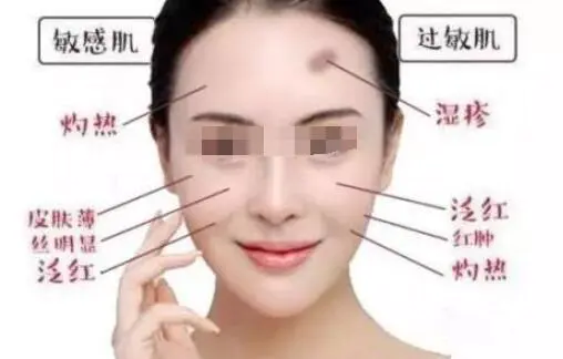 怎么样去除痘印最有效(讲解脸上的痘印该如何祛除)插图1 怎么样去除痘印最有效(讲解脸上的痘印该如何祛除)插图1