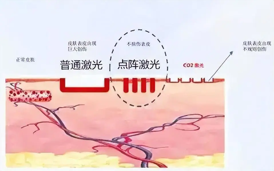 怎么样祛痘坑比较好(分享去痘坑最快的方法有哪些)插图1 怎么样祛痘坑比较好(分享去痘坑最快的方法有哪些)插图1