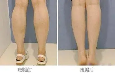 怎么样瘦小腿效果最快(解读如何做能帮自己瘦小腿)插图1 怎么样瘦小腿效果最快(解读如何做能帮自己瘦小腿)插图1
