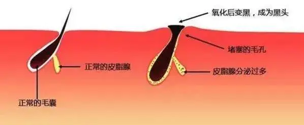粉刺针怎么用去黑头(解读彻底去黑头的小妙招)插图 粉刺针怎么用去黑头(解读彻底去黑头的小妙招)插图