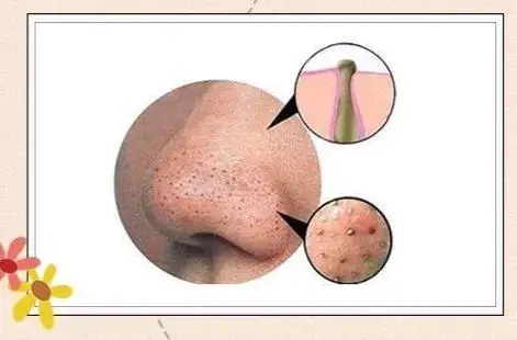 粉刺针怎么用去黑头(解读彻底去黑头的小妙招)插图1 粉刺针怎么用去黑头(解读彻底去黑头的小妙招)插图1