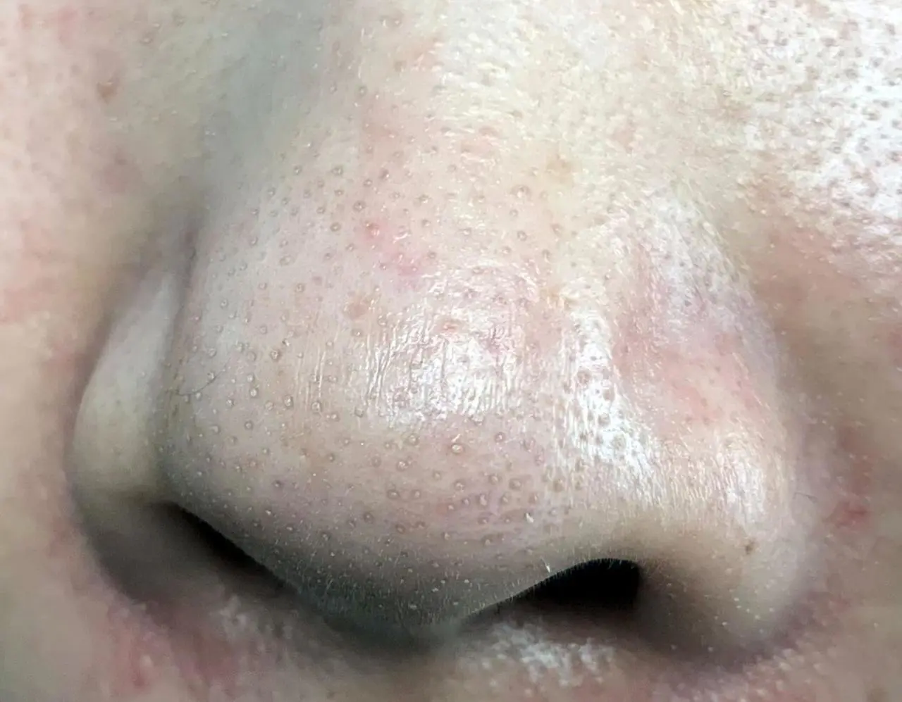 黑头导出液怎么用的(介绍怎样让这样脏兮兮的脸变得白净点)插图 黑头导出液怎么用的(介绍怎样让这样脏兮兮的脸变得白净点)插图