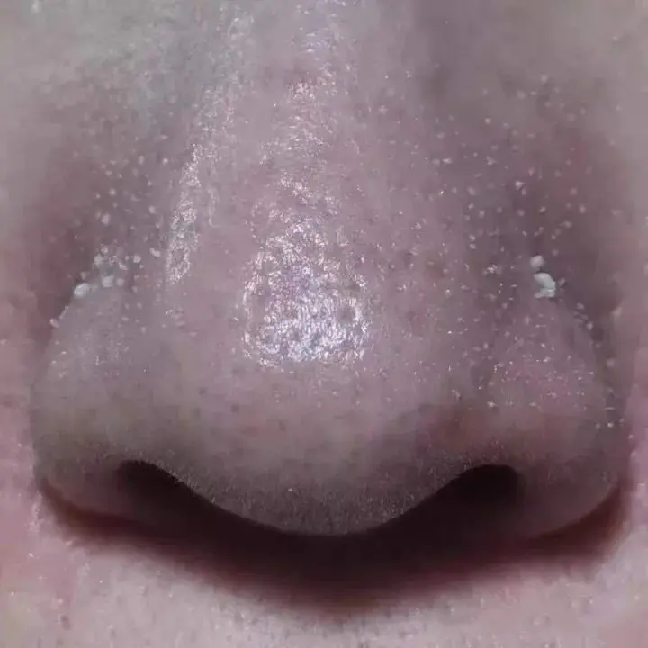 黑头导出液怎么用的(介绍怎样让这样脏兮兮的脸变得白净点)插图7 黑头导出液怎么用的(介绍怎样让这样脏兮兮的脸变得白净点)插图7
