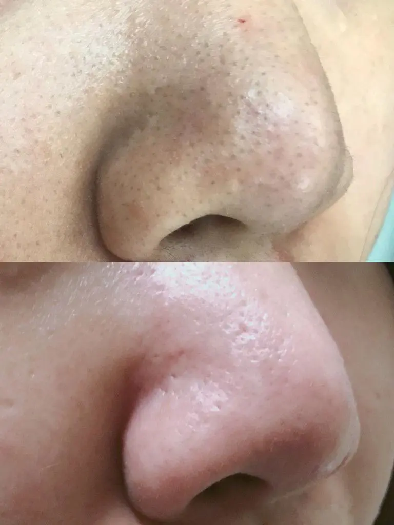 黑头导出液怎么用的(介绍怎样让这样脏兮兮的脸变得白净点)插图9 黑头导出液怎么用的(介绍怎样让这样脏兮兮的脸变得白净点)插图9