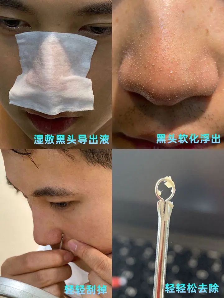 黑头导出液哪个好用(解读最好用的去黑头产品是哪款)插图1 黑头导出液哪个好用(解读最好用的去黑头产品是哪款)插图1