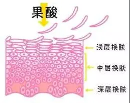 果酸换肤效果怎么样(介绍果酸换肤有用吗)插图 果酸换肤效果怎么样(介绍果酸换肤有用吗)插图