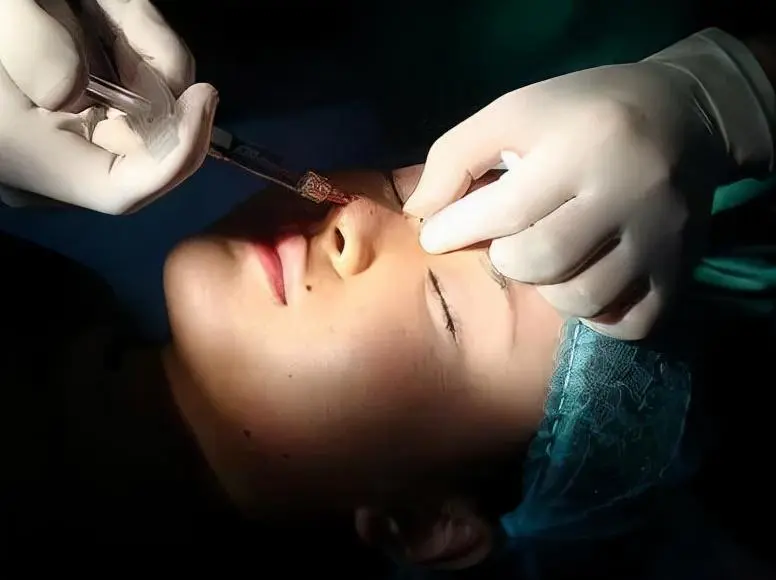 玻尿酸隆鼻怎么样(分析玻尿酸隆鼻是否适合所有人)插图1 玻尿酸隆鼻怎么样(分析玻尿酸隆鼻是否适合所有人)插图1