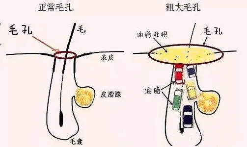 怎么样才能去黑头最有效(讲解去黑头最有效的6个方法)插图4 怎么样才能去黑头最有效(讲解去黑头最有效的6个方法)插图4