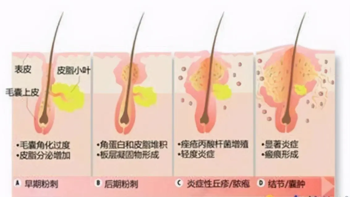 怎么样才能去除痘印痘坑(介绍如何去除痘印痘坑)插图1 怎么样才能去除痘印痘坑(介绍如何去除痘印痘坑)插图1