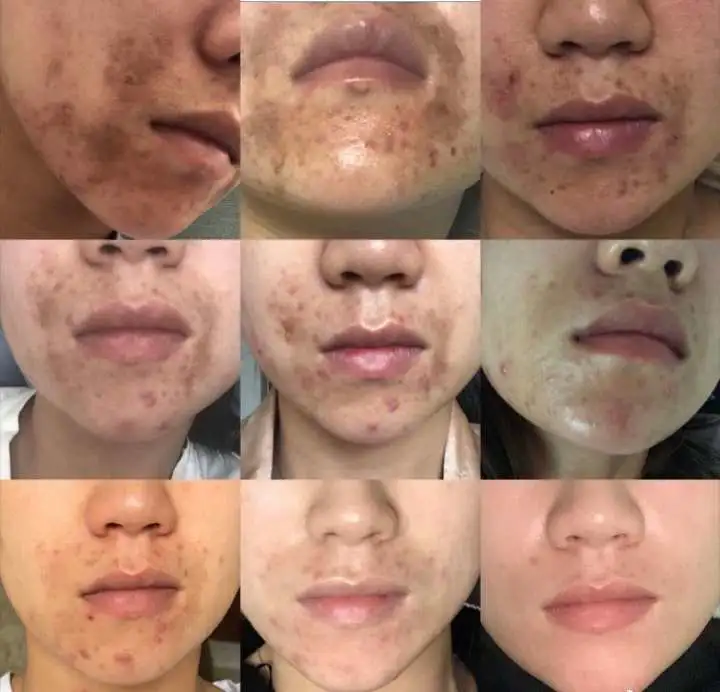 怎么样才能去除痘印痘坑(介绍如何去除痘印痘坑)插图4 怎么样才能去除痘印痘坑(介绍如何去除痘印痘坑)插图4