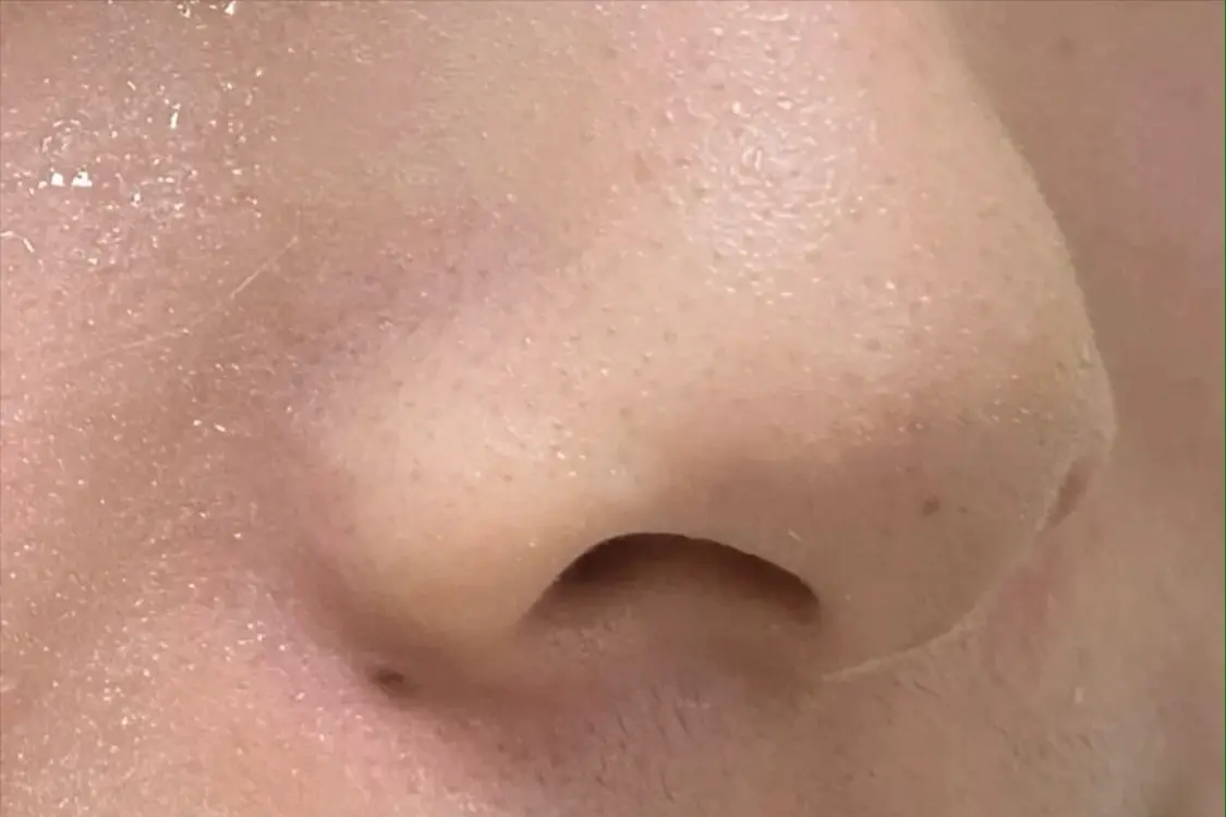 怎么用粉刺针去黑头(解析如何跟黑头粉刺痘痘说再见)插图1 怎么用粉刺针去黑头(解析如何跟黑头粉刺痘痘说再见)插图1