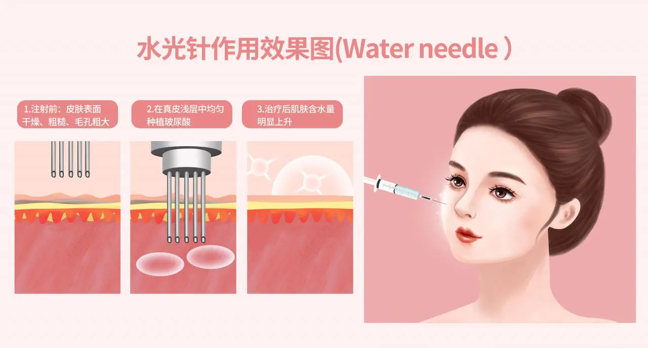 做一次无针水光后不做了会怎么样(解析为什么要打水光针停打会有副作用吗)插图 做一次无针水光后不做了会怎么样(解析为什么要打水光针停打会有副作用吗)插图
