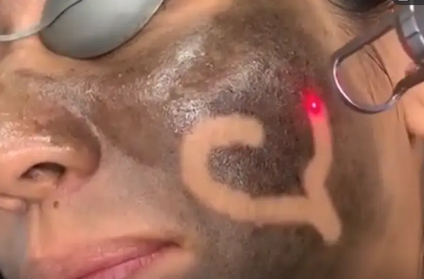做黑脸娃娃效果怎么样（讲解比美白针靠谱的美白项目有哪些）插图9