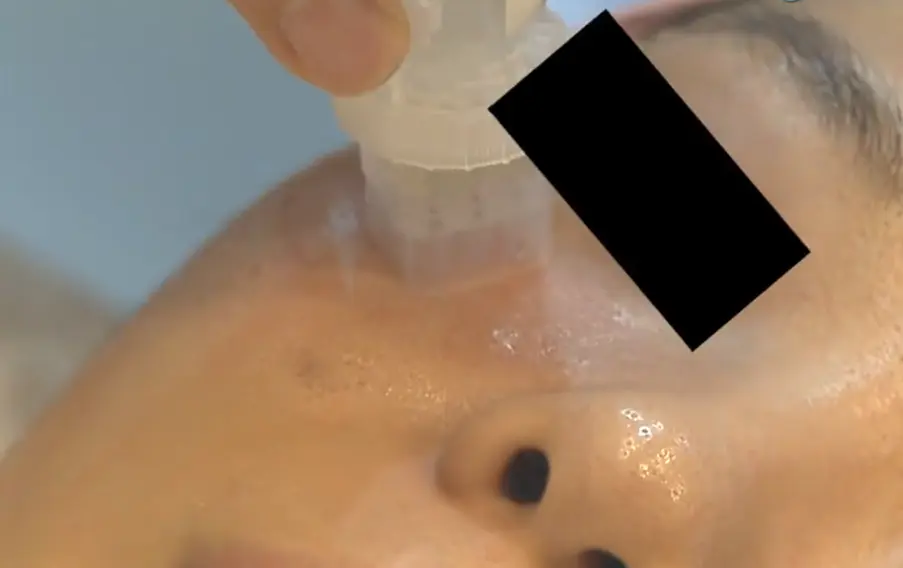 做黑脸娃娃效果怎么样（讲解比美白针靠谱的美白项目有哪些）插图10